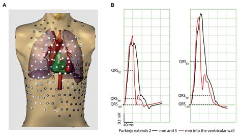 Frontiers | Why Ablation of Sites With Purkinje Activation Is Antiarrhythmic: The Interplay ...