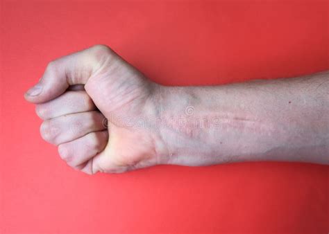 A Scar on the Wrist from Tendon and Nerve Surgery, a Cut on the Hand Stock Image - Image of ...