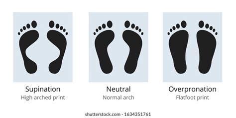 362 Supinated Foot Images, Stock Photos & Vectors | Shutterstock