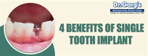 4 Benefits of Single Tooth Implant – Tech, Business, Digital Marketing ...