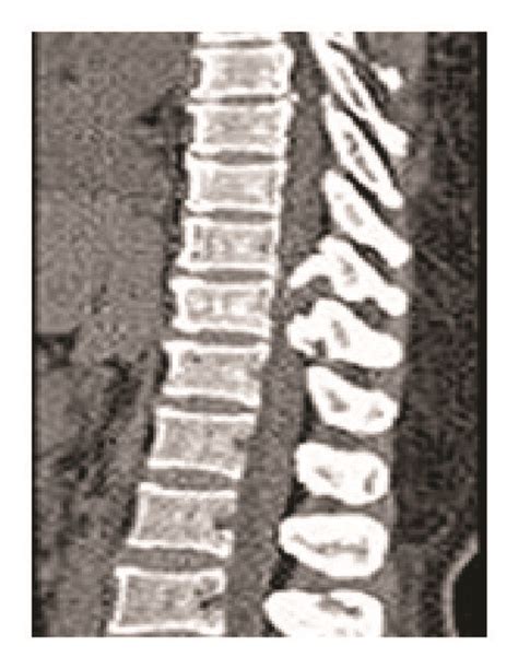 CT thoracic spine shows T10-T11 vertebral body and disc regeneration. | Download Scientific Diagram