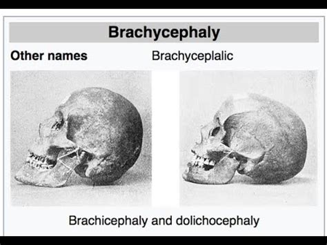 Dolichocephalic/Basics of Anatomy/Anthropology Optional - YouTube