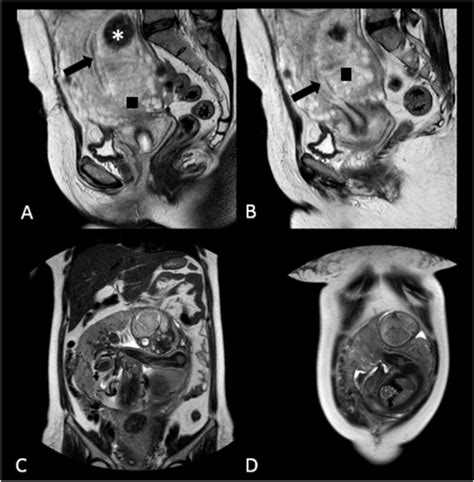 Interstitial pregnancy. Initial interpretation of magnetic resonance ...