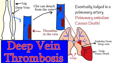 Deep vein Thrombosis (DVT) - Symptoms, diagnosis and treatment. Homan sign - YouTube