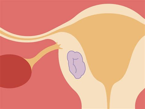 Intramural Fibroid: Symptoms, Diagnosis, and Treatment