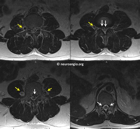 Archives Batson Venous Plexus | neuroangio.org