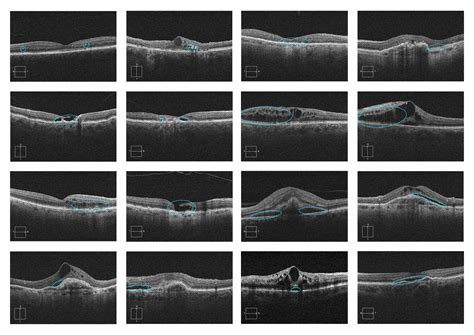 INTERPRET: Macular OCT - EyeCarePD