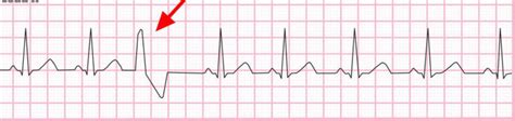 pvc-sinus-rhythm - Cardiac Sciences Manitoba