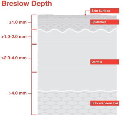 Breslow Depth and Clark Level - Melanoma Research Alliance