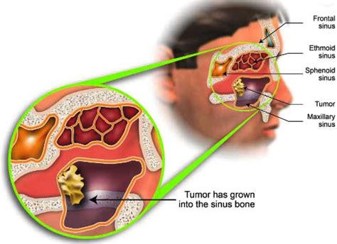 Nasal Cavity Cancer Treatment in India, Cost Treatment Surgery Top ...