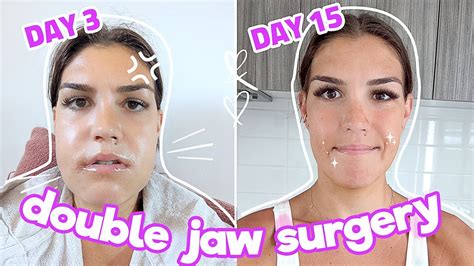 My Double Jaw Surgery Experience (2 WEEKS POST SURGERY!) Ep. 5 - YouTube