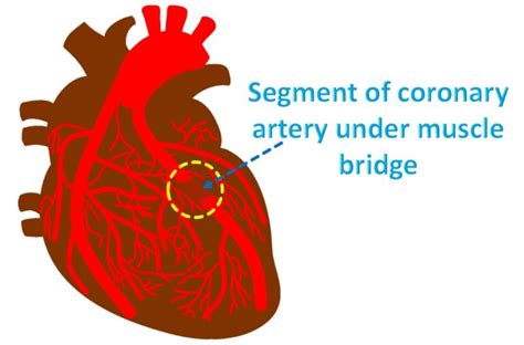 What is a myocardial bridge? – All About Heart And Blood Vessels