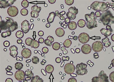 Calcium Oxalate Crystals in Urine: Symptoms, and Treatment