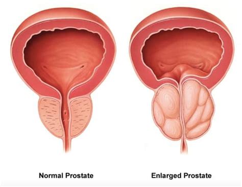 Benign Prostatic Hypertrophy (BPH) Prostate enlargement South West ...