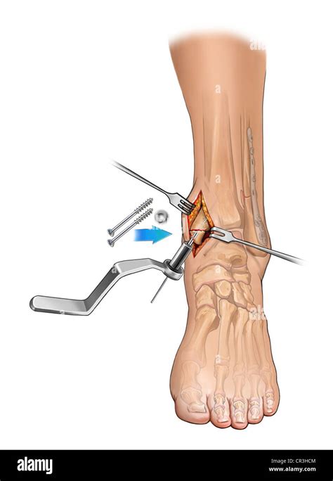 Medial Malleolus Ankle Fracture : The Radiology Assistant Ankle Fracture Weber And Lauge Hansen ...