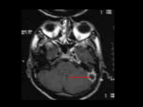 Complications of CSOM (Chronic Suppurative otitis Media)