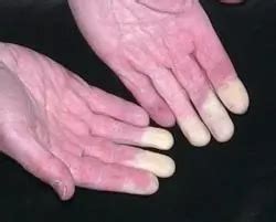 Vibration White Finger: Causes, Risk factors, Diagnoses, Treatment & Prevention - HSEWatch