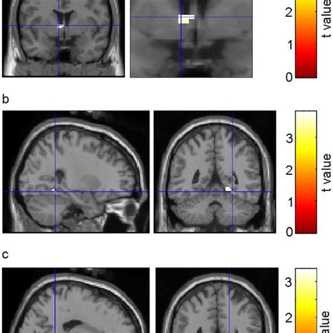 Activation of ventral striatum and ventromedial prefrontal cortex... | Download Scientific Diagram