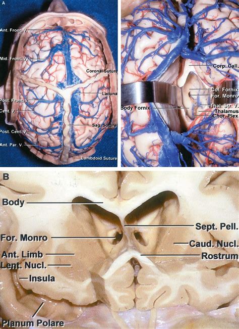 External Ventricular Drain | The Neurosurgical Atlas, by Aaron Cohen ...