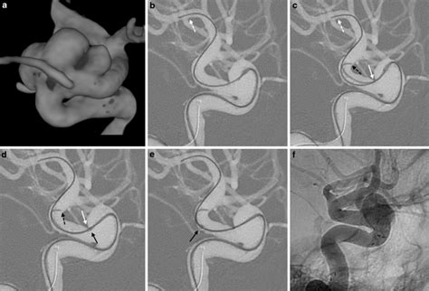 Female patient with an incidental right paraophthalmic ICA aneurysm ...