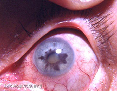 Heterochromia iridis caused by chronic cyclitis. EyeRounds.org: Online Ophthalmic Atlas