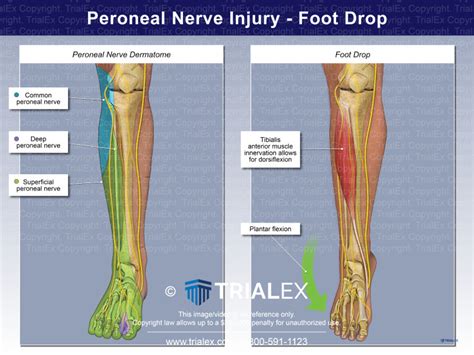 Peroneal Nerve Injury - Foot Drop - Trial Exhibits Inc.