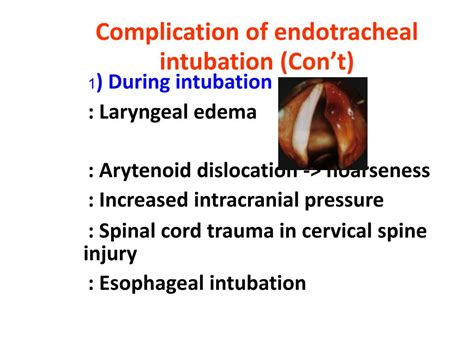 PPT - ENDOTRACHEAL INTUBATION PowerPoint Presentation, free download - ID:4861562