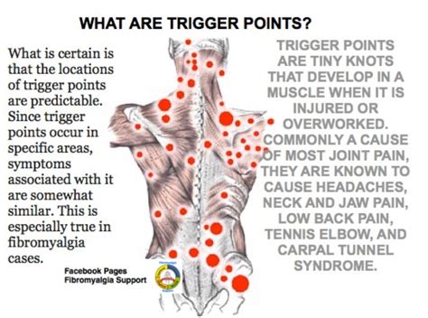 Fibromyalgia trigger points Fibromyalgia Trigger Points, Fibromyalgia ...