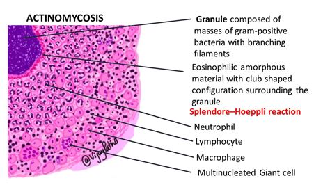 ACTINOMYCOSIS | Pathology Made Simple