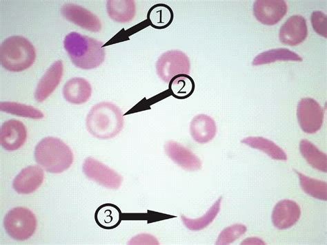 (1) Nucleated red cell, (2) target cell, and (3) irreversibly sickled... | Download Scientific ...