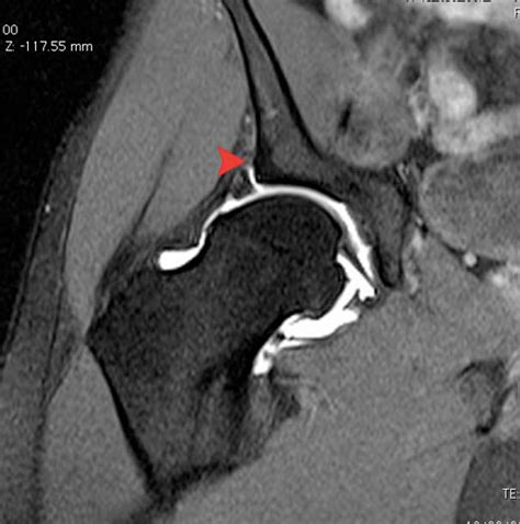 Pain in hip at night only 2014, flexeril 10mg overdose, labral tear in hip joint yoga