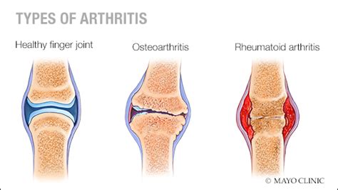 Mayo Clinic Q and A: Understanding osteoarthritis and rheumatoid arthritis - Mayo Clinic News ...