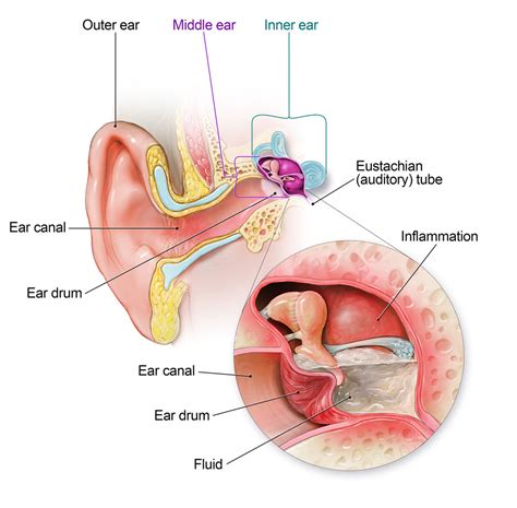 Get Smart About Antibiotics | Ear Infection | CDC