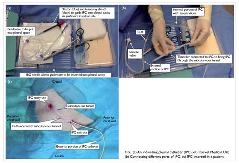 Indwelling Pleural Catheter