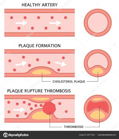 Atherosclerosis Stages Healthy Artery Plaque Formation Thrombosis Flat Style Isolated — Stock ...