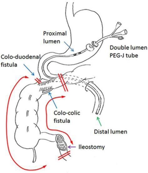 Schema showing the gastro-jejunostomy tube, the locatio | Open-i