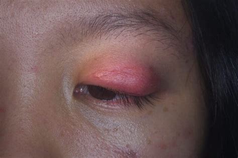 Cellulitis of the Eye (Orbital Cellulitis) – NVISION