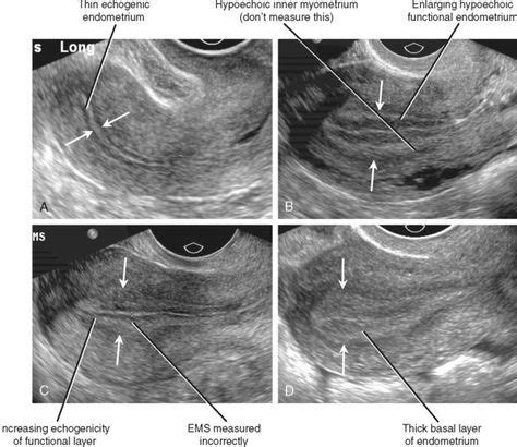 Cycle-related changes in the appearance of the endometrial stripe (EMS) on transvaginal ultrasou ...