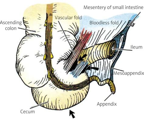 A semi-realistic figure of the vermiform appendix along | Open-i