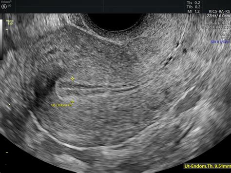 Endometrial Hyperplasia Classification: Improving Diagnoses | Empowered Women's Health