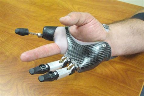 Finger and Partial Hand Prosthetic Options | Arm Dynamics