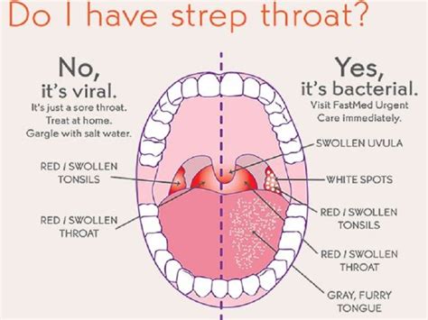 Strep Throat Home Remedies : Human N Health