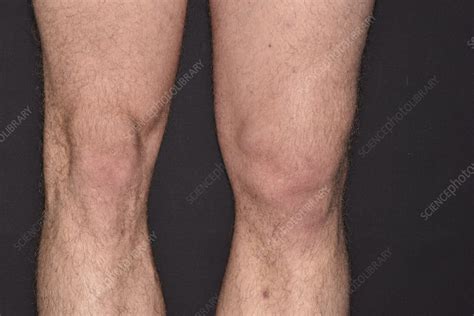 Dislocated knee - Stock Image - C028/4518 - Science Photo Library