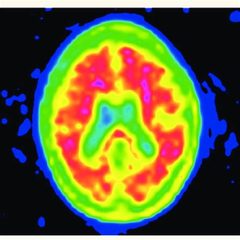 Amyloid PET scan in Alzheimer's disease. Colour image of an amyloid PET... | Download Scientific ...