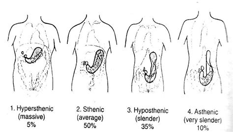 Hypersthenic Body Habitus