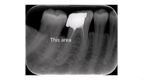 Vertical Versus Horizontal Bone Loss in Posterior Teeth - YouTube