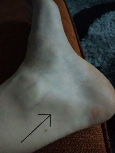 Mild swelling behind the medial malleolus. | Download Scientific Diagram