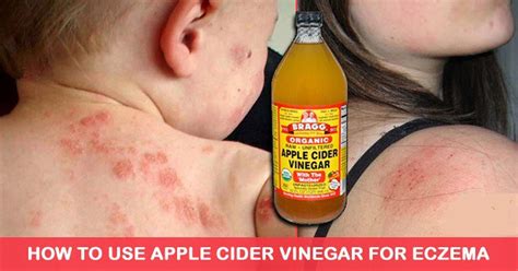 How To Use Apple Cider Vinegar To Fight Eczema Naturally