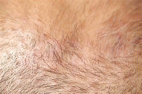 Vellus Hair to Terminal Hair – Hair Growth Cycle Guide - Hairguard