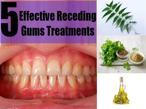 5 Effective Receding Gums Treatments